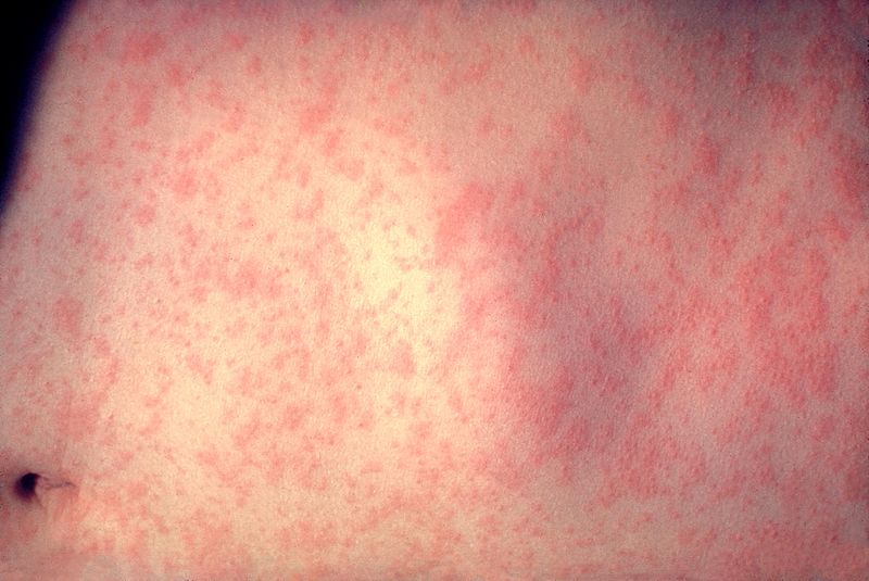 A child with measles; photo courtesy CDC