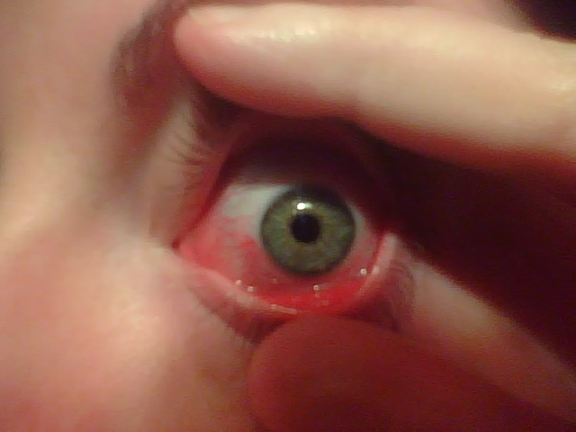 An early case of pinkeye; photo courtesy EvilQueenAcidBurn